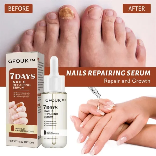 7 Days Nail Repair Essence Restores Hand Foot Onychomycosis Rotten Toenail Soft Nail Thickening Moisturize Care Nails Products