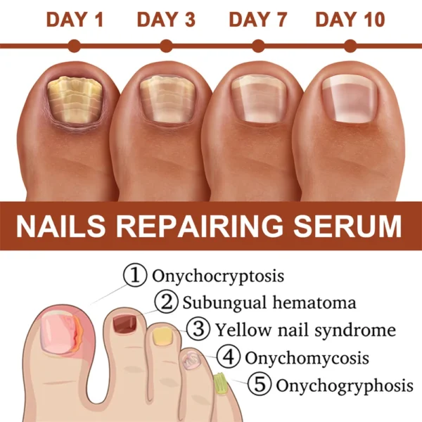 7 Days Nail Repair Essence Restores Hand Foot Onychomycosis Rotten Toenail Soft Nail Thickening Moisturize Care Nails Products - Image 2